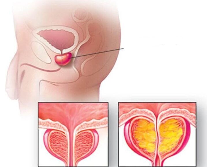 Locatie van de prostaatklier, normale prostaat en vergroot bij chronische prostatitis
