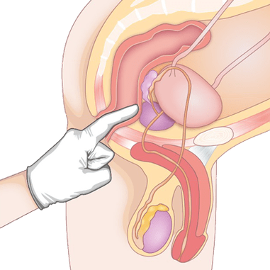 Bepaling van de toestand van de prostaat door palpatie voor de diagnose van prostatitis