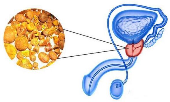 Problemen met prostatitis