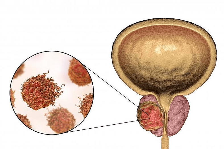 hoe ziet prostaatschade eruit