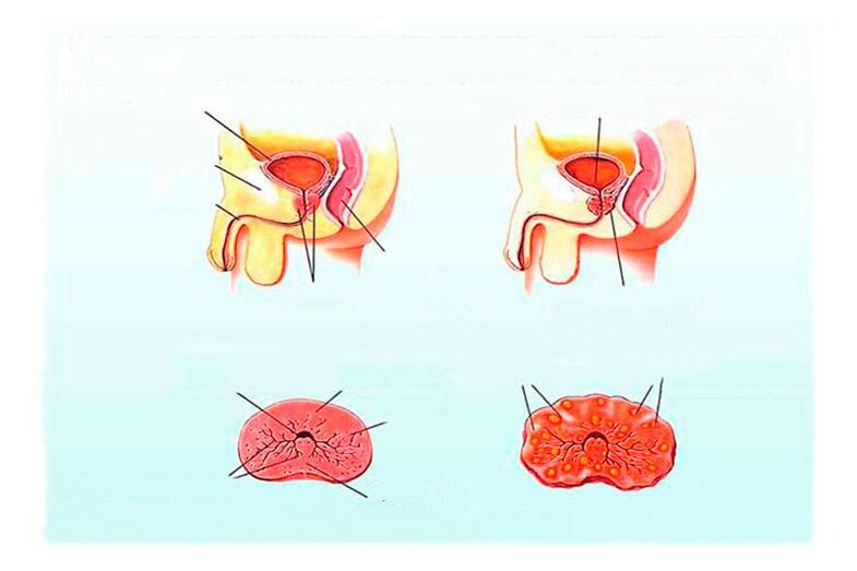 Tekenen van chronische prostatitis