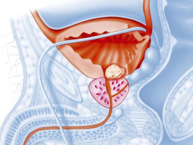 Bacteriële prostatitis