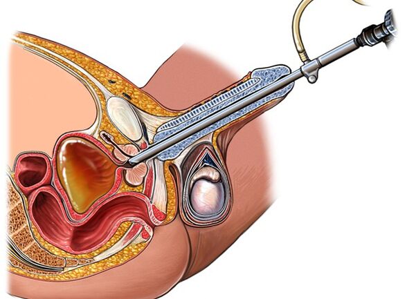 Behandeling van prostatitis