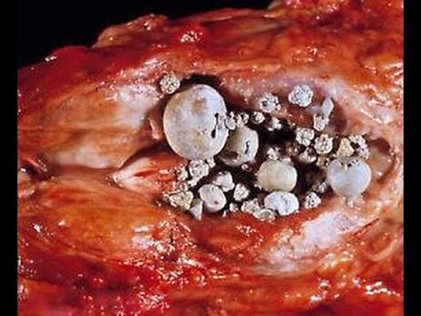 Berekende prostatitis