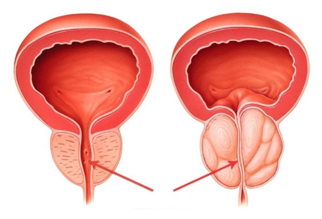 gezonde en ontstoken prostaat met prostatitis