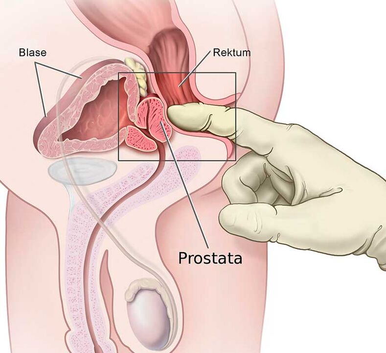 prostaatmassage voor prostatitis